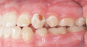 Tooth Rotting from not brushing